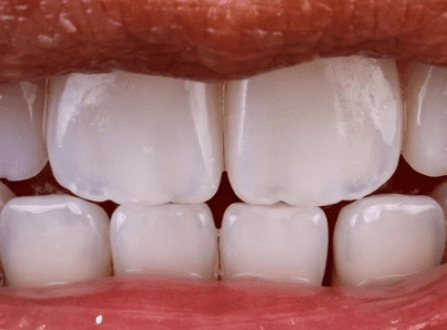 resin composite veneers