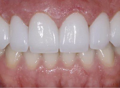fake porcelain veneers