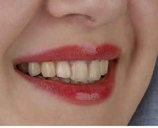 Don’t Fall for the Porcelain Veneer Trap! Why Natural Teeth Are Stronger Than Veneers