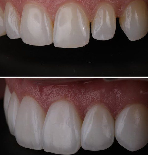 resin composite bonding veneers