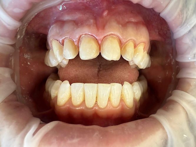 Ground down teeth from porcelain veneers