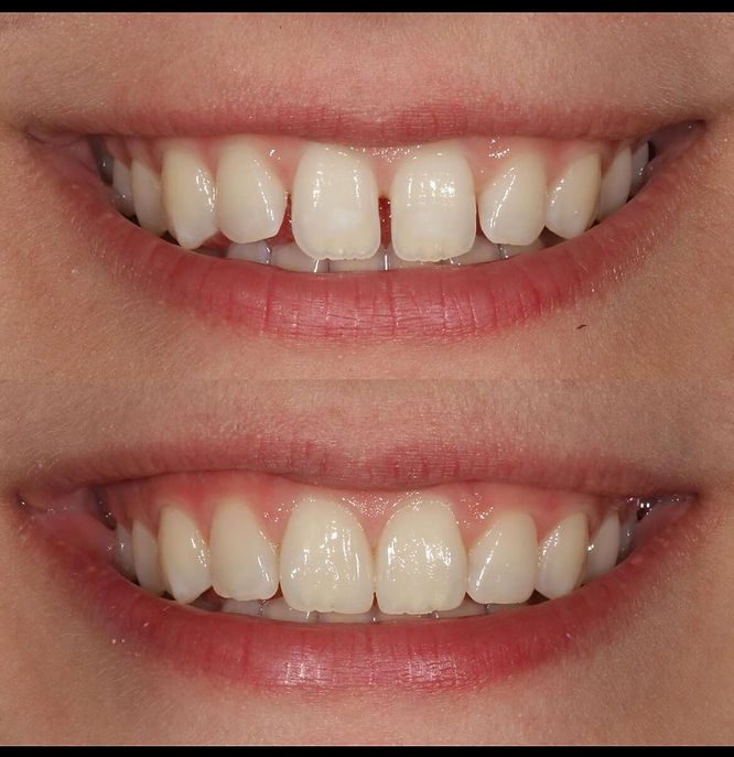 6 Zero Prep Direct Composite Veneers