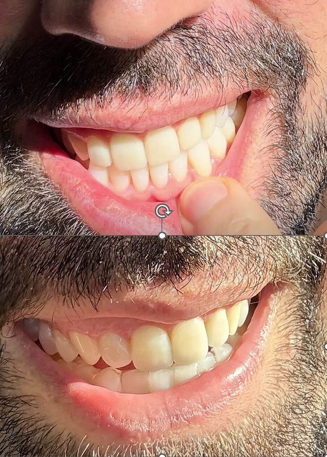 porcelain veneers vs composite bonding