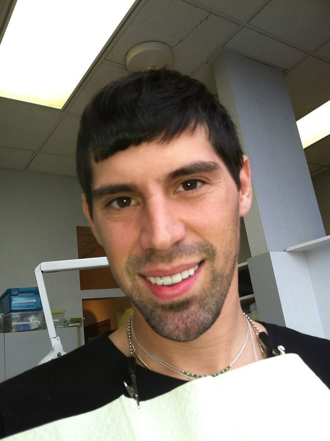 Actual porcelain veneer try-in photo from 2012. I didn’t recognize myself and wished I could have my natural teeth back.