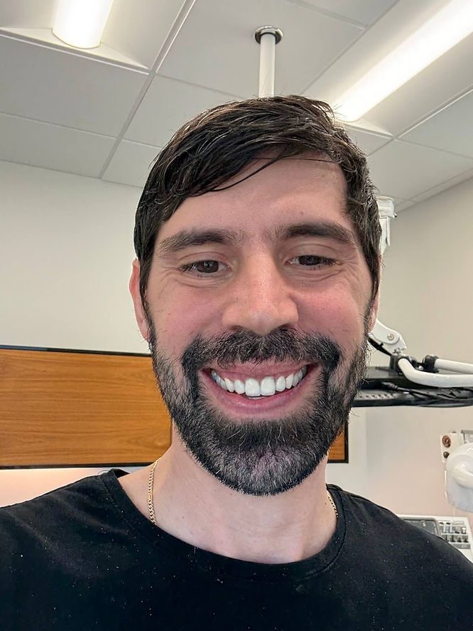 While the gums were still healing, this was one of the final photos taken. You can see the canines had been reshaped and contoured completely differently from the day before