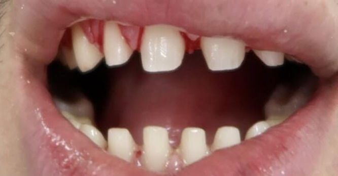 porcelain veneers preparation