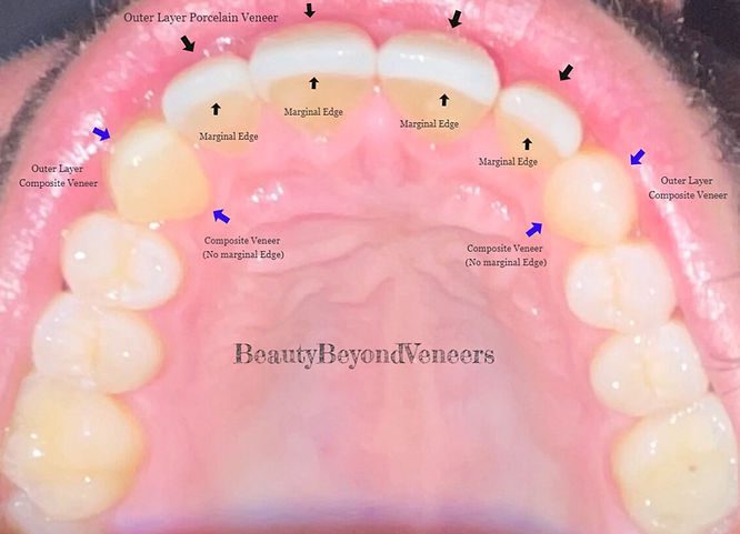 Patient with Porcelain Veneers with Marginal edge on back side of the tooth