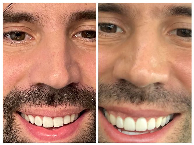 Over the years (2012 to 2023) , Dr. Kang carefully ground down the porcelain and replaced it with composite, gradually making my teeth more functional. He helped me speak and eat more comfortably and adjusted the length so they fit better in my mouth. However, because porcelain is ceramic, all the fine detail and definition were lost during the process.