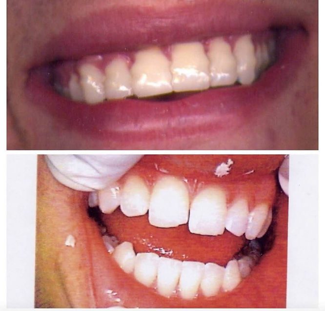 Before and after my first porcelain veneer procedure in 2003