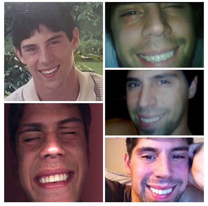 Top left shows my natural teeth. The rest show the porcelain veneers — noticeably bulky, fake, and much larger than what I started with.