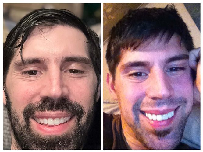 Left: Resin composite bonding/veneers by Dr. Jordan Davis at Arete Smile Design (2025).
Right: Porcelain veneers from 2003 that looked fake and unnatura