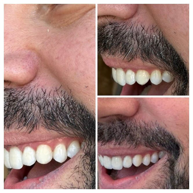 Image on the left is the first photo, the top right is the second, and the bottom right is the third. You can see how the canine was gradually textured to resemble a natural tooth more closely with each adjustment. After every change, I would look in the mirror and give feedback until we got it just right. Dr. Davis was incredibly patient and skilled throughout the entire process.