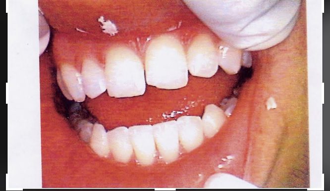 Natural Teeth