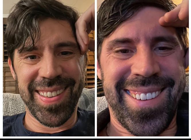 Left image (2023): After Dr. Kang smoothed down the porcelain and added composite to the canines, which had been previously ground down, along with removing the porcelain from the bicuspids. Right Image Porcelain veneers originally placed by Dr. Landers, partially adjusted by Dr. Kang but still not fully corrected. (2022)