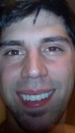 bad porcelain veneers
