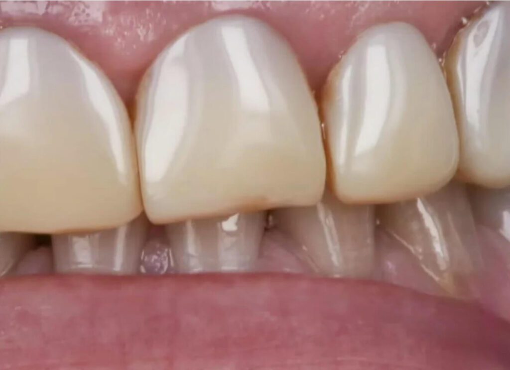 porcelain veneers stain