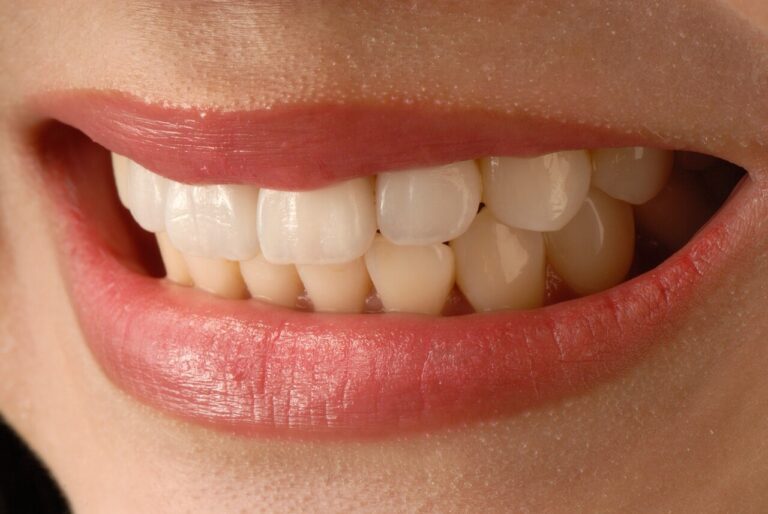 close-up of a person's mouth and teeth porcelain veneer