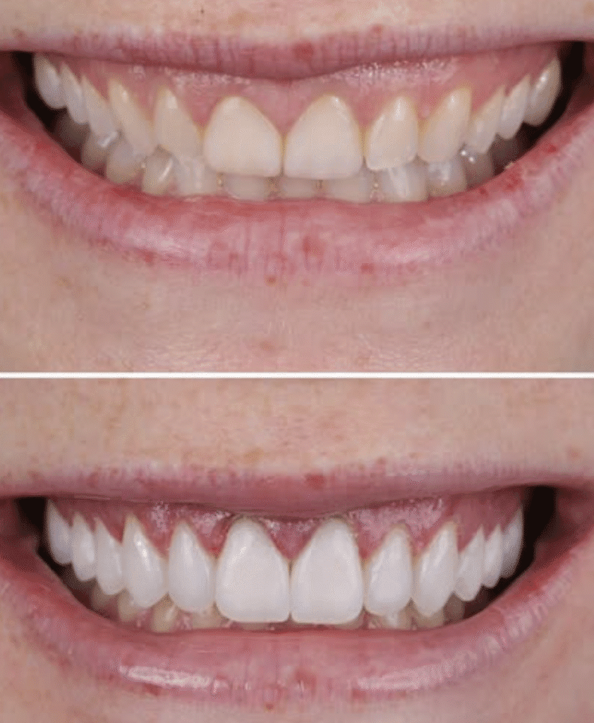 Dr. Jordan Davis Enhanced Composite Veneers
