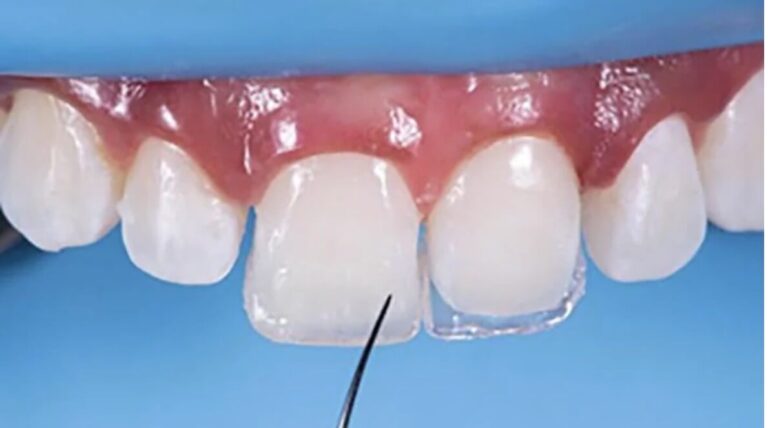 Close-up of teeth with a dental tool near one tooth, indicating a dental procedure. The background is blue, and the mood is clinical.