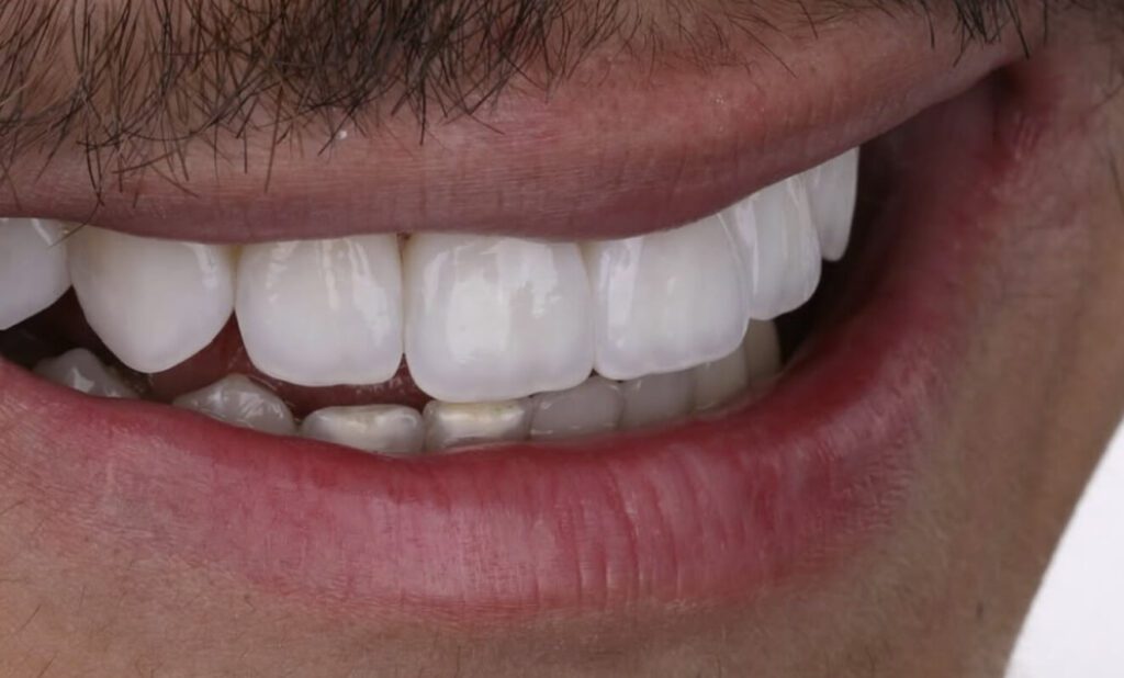 close up of a person's mouth and rafted by Dr. Jordan Davis in Utah, these enhanced composite veneers offer superior stain resistance and durability compared to older bonding technique