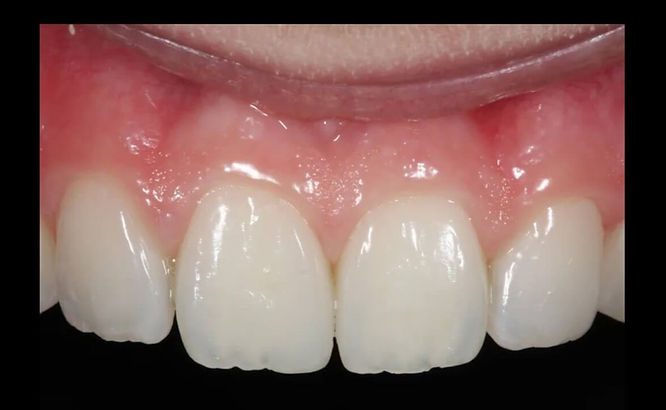 Composite resin veneers