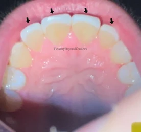 porcelain veneers back of teeth