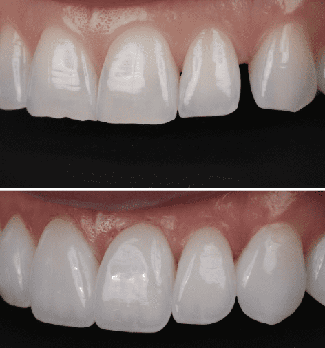 Composite bonding my Dr. Jordan Davis