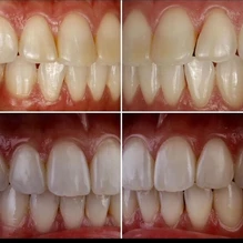 composite resin veneers