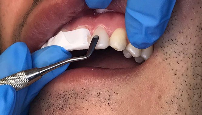 composite bonding