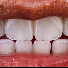 composite resin veneers