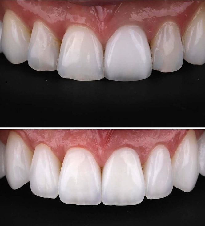 resin composite veneers, Dr. Jordan davis