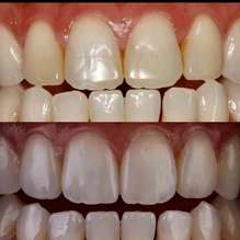 composite resin veneers