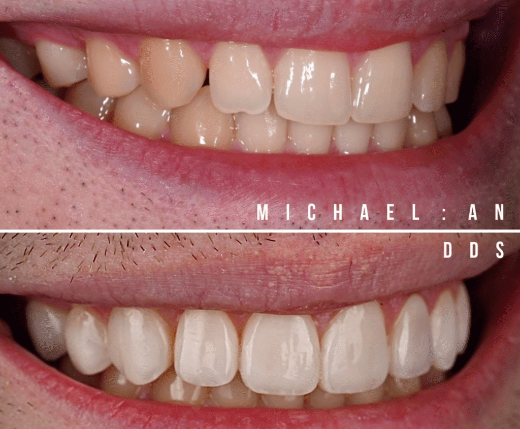 Beneath the Veneer: The Dark Side of Celebrity Porcelain Veneers Before and After Pictures 8 image 9