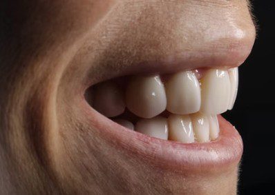 promoting porcelain veneers