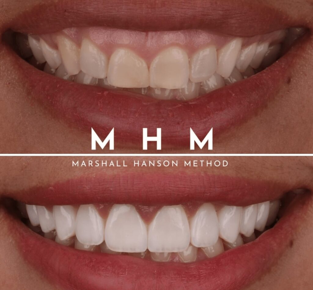 Resin Veneers by Dr Marshall Hanson
