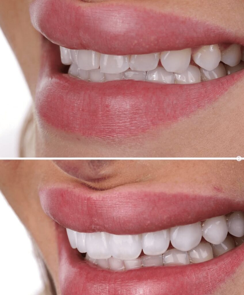 Resin Veneers by Dr Jordan Davis