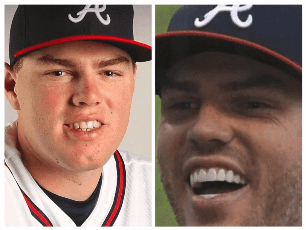 freddie freeman teeth