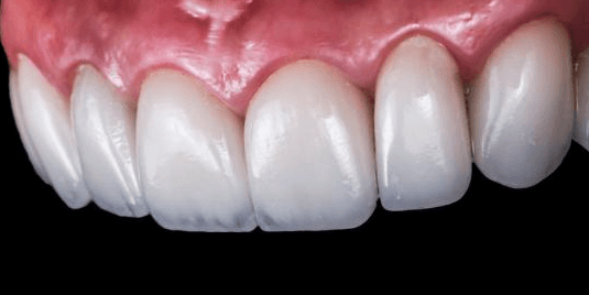 porcelain veneers