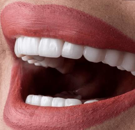 smile with porcelain veneers