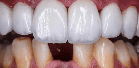 porcelain veneer bite problems