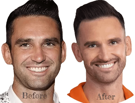 carl radke before and after veneers