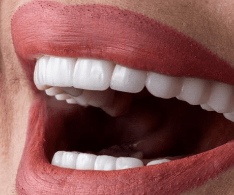 porcelain veneer regret