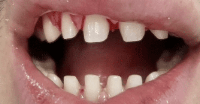 What Does Teeth Look Like Under Veneers: Why The Before And After Photos Are Misleading 2 image 15