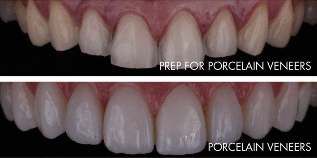 What Does Teeth Look Like Under Veneers: Why The Before And After Photos Are Misleading 6 image 17