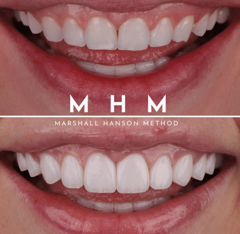 What Does Teeth Look Like Under Veneers: Why The Before And After Photos Are Misleading 8 image 20