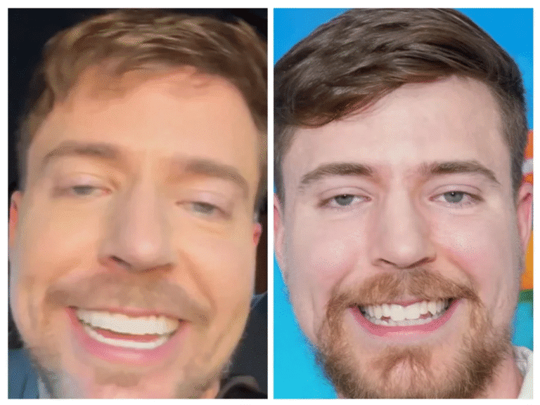 MrBeast Veneers: A Smile He’ll Never Get Back 10 MrBeast Veneers: A Smile He’ll Never Get Back