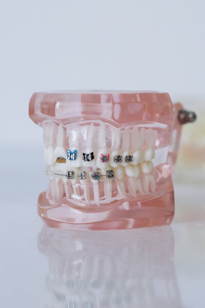 Porcelain Veneer Costs: The Real Price, Lifetime Expenses, and Safer Alternatives 2 Close-up of a dental model showcasing braces in a clinical setting.