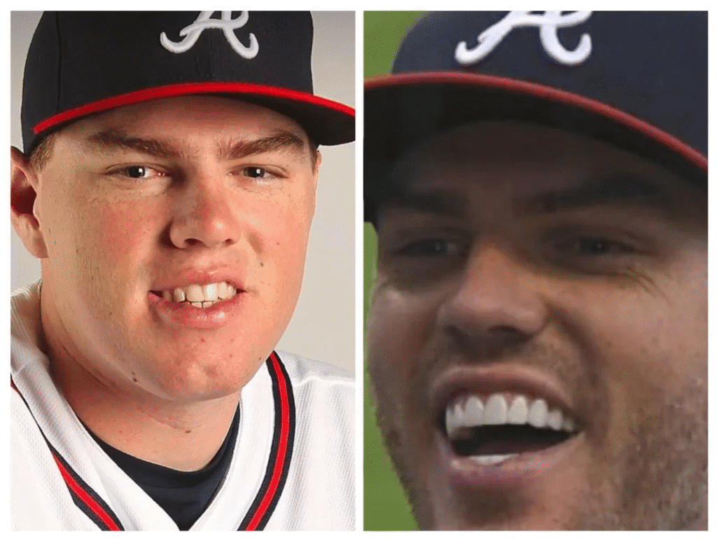 Side-by-side comparison of Freddie Freeman before veneers with natural teeth, and after veneers with bright, uniform porcelain teeth