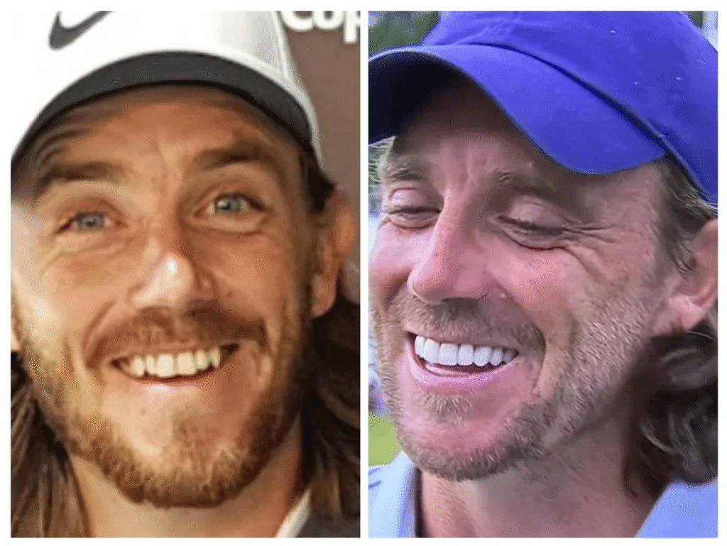 What Happened to Tommy Fleetwood’s Teeth? Porcelain Veneers and the Smile That Erased His Character 1 Tommy Fleetwood smile transformation side by side showing natural teeth on the left before cosmetic work and porcelain veneers on the right that appear brighter and whiter but lack original character