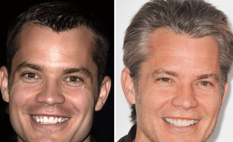 Side-by-side comparison of Timothy Olyphant smiling in two different photos. On the left, a younger Olyphant shows his natural, slightly imperfect teeth. On the right, an older Olyphant displays a brighter, more uniform smile likely enhanced by porcelain veneers